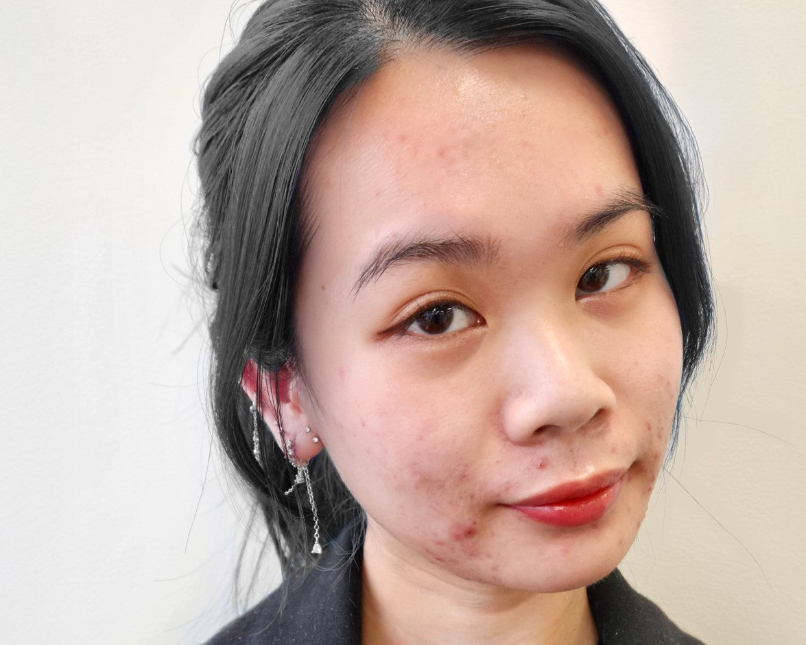 blog - adult-acne